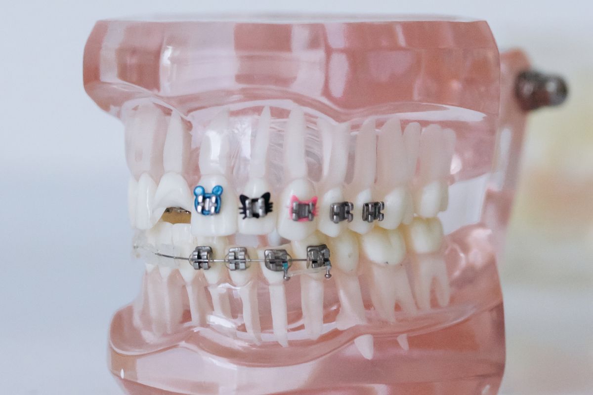 Modelo dental con brackets de ortodoncia