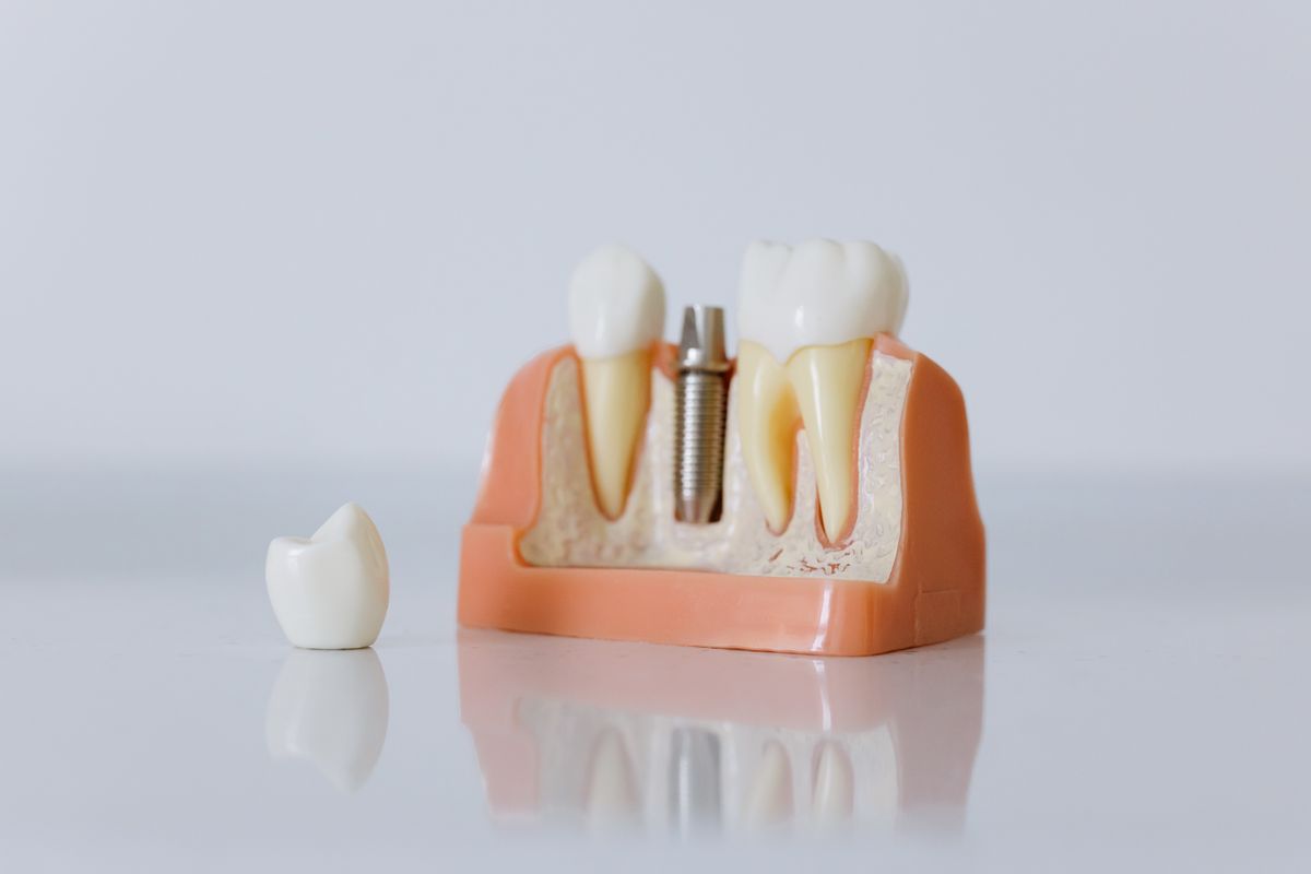 Modelo de implante dental junto a dos dientes