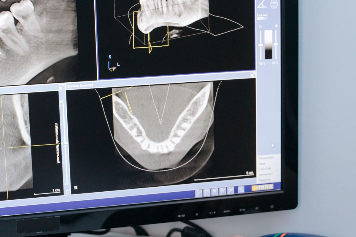Imagen de TAC dental en pantalla